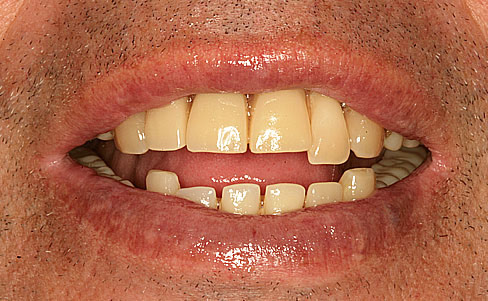 Dental implants - before