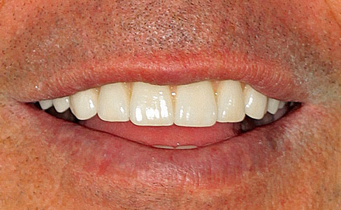 Dental implants - after