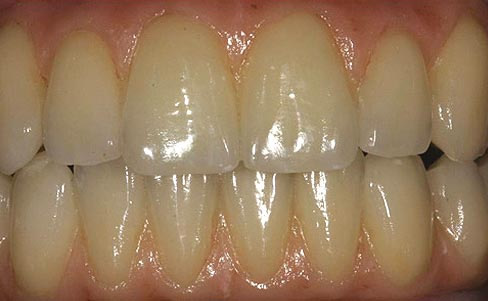 Removable dentures - after