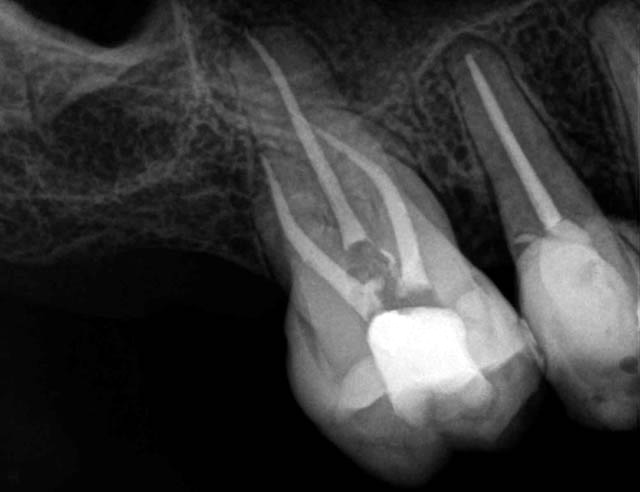 Root canal work - after