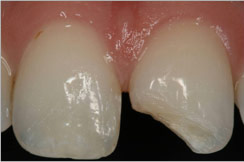 Broken tooth restoration - before