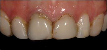 Dental veneers - before
