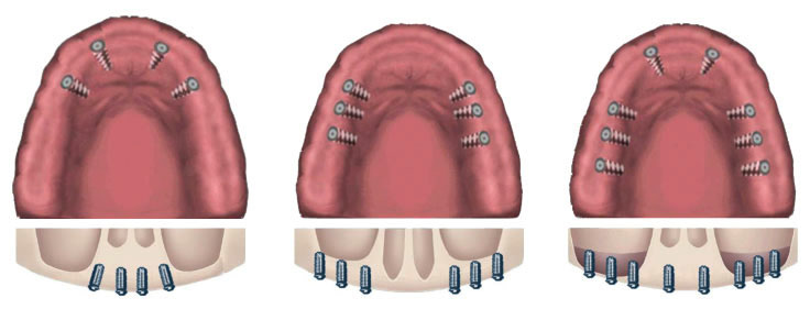 Number of dental implants