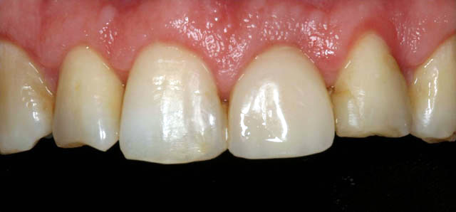 Prosthodontics - before
