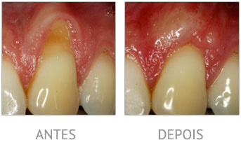Gum recession - before and after